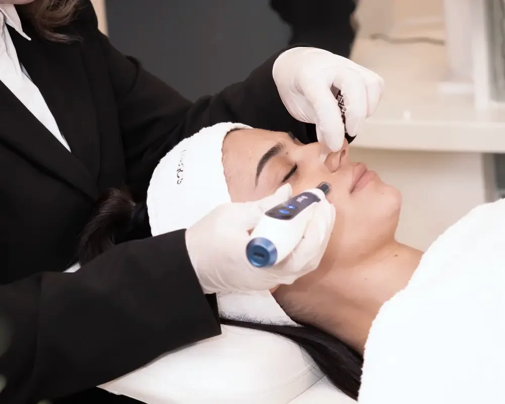 Microneedling Zalm DNA bij Zina Beauty