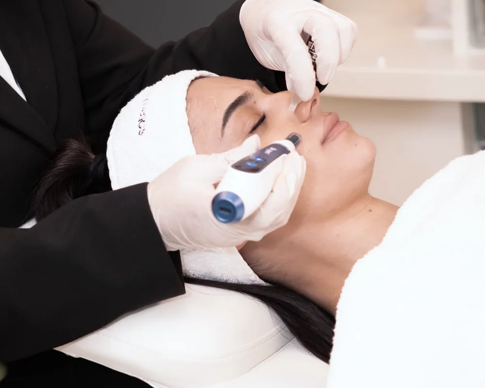 Microneedling Zalm DNA bij Zina Beauty